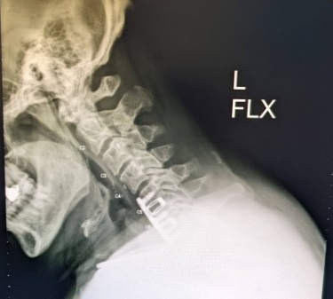 Name:  Neck X-Ray, L-Flex, Jun 2022 - cropped.jpg
Views: 1615
Size:  30.2 KB